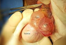 What’s Causing This Cyst?
